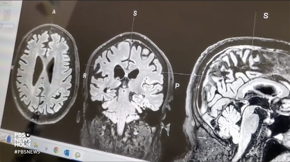 A computer monitor with a brain scan from three angles on the screen